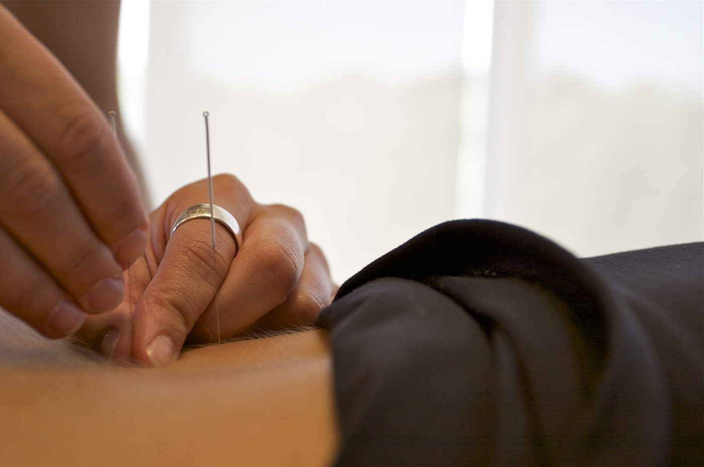 Acupuncture in Waterloo: acupuncture needles being placed in a patient’s back